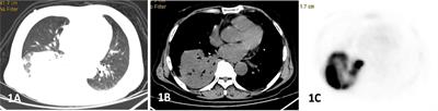 Role of 18F-FDG PET/CT in patients affected by pulmonary primary lymphoma